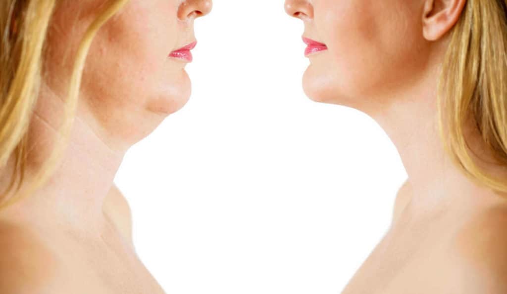 Double Chin treatment Birkenhead before and after results