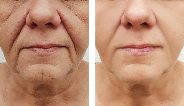 Learn more about Morpheus8 Treatment Birkenhead today!