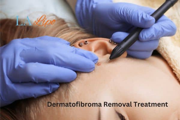 Dermatofibroma Removal Treatment Birkenhead