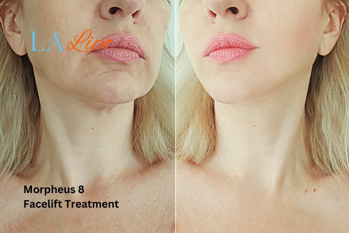 Turn back time with Morpheus8 Treatment Birkenhead