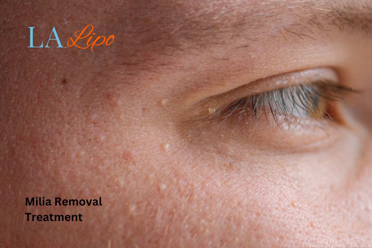 Cryopen Milia Removal: Is It the Easiest and Safest Option Birkenhead?