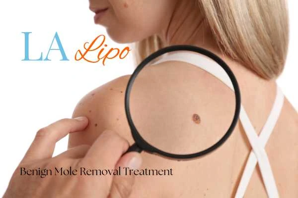 Why getting moles removed Birkenhead can boost your confidence!