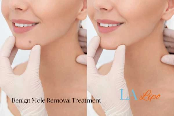 woman's before and after mole removal Birkenhead results