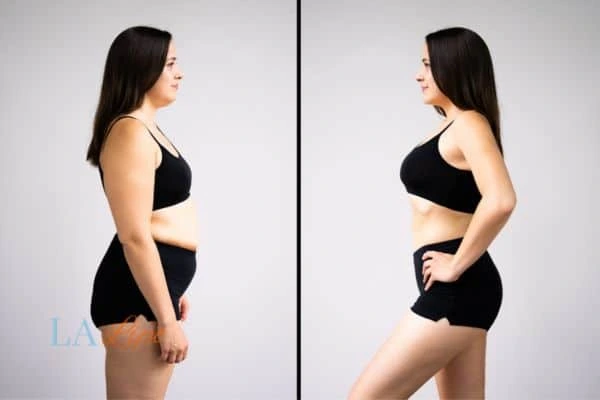 image of woman before and after results of LA-EMS Body Sculpting Birkenhead to help treat Diastasis recti