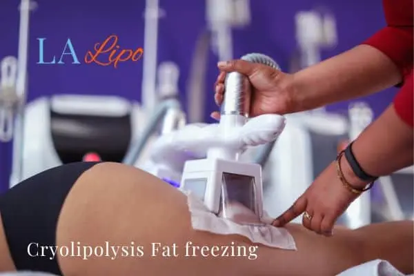 women getting fat freezing Birkenhead