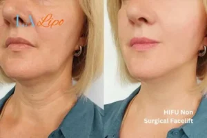 hi-fu for wrinkles Birkenhead before and after results