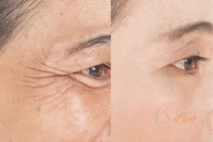 Before and after results of woman - HI-fu wrinkles reduction treatment Birkenhead