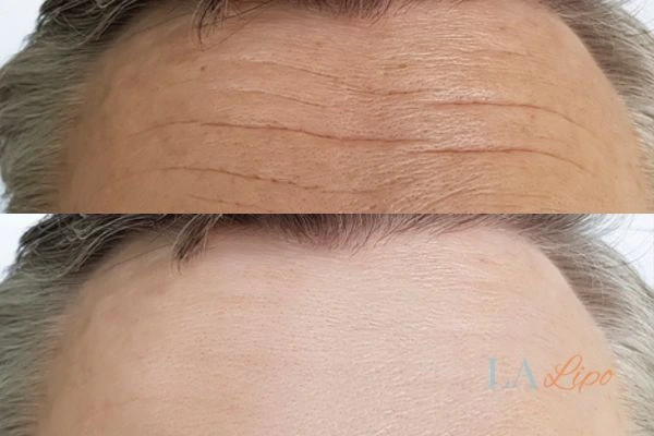 results of HIFU Birkenhead on mans forehead to help reduce lines and wrinkles