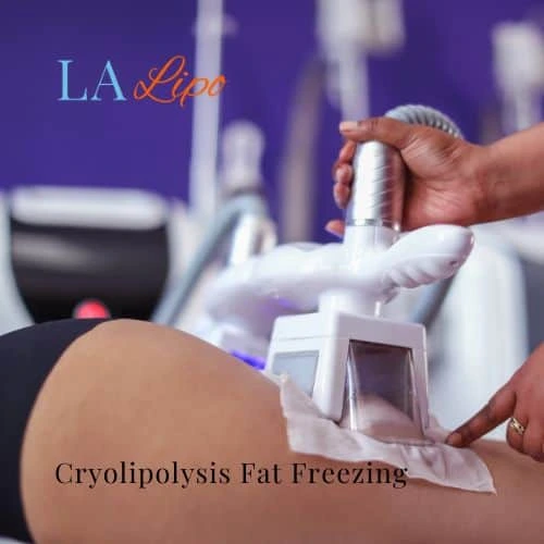 fat freezing - Cryolipolysis Birkenhead