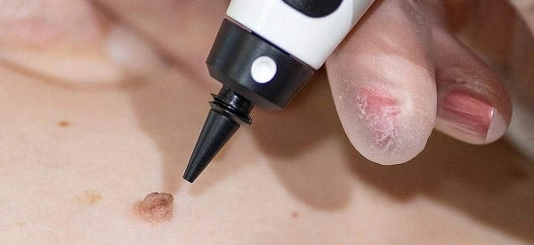 skin tag removal using cryopen Birkenhead