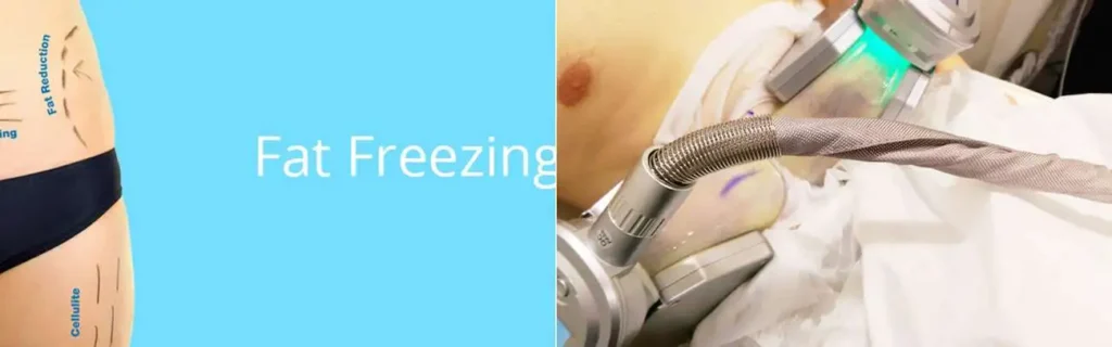 multi areas of a persons body having coolsculpting Birkenhead treatment