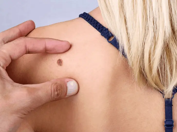 woman having mole removal Birkenhead consultation before treatment.