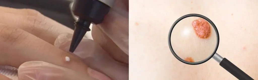 Cryopen for mole removal Birkenhead - speak to our team today!
