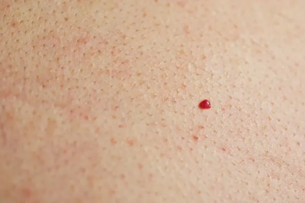 close up of a cherry angioma Birkenhead