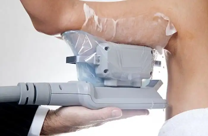 Picture of fat freezing Birkenhead on the upper arms.