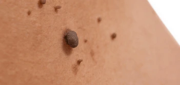 image of a skin tag Birkenhead