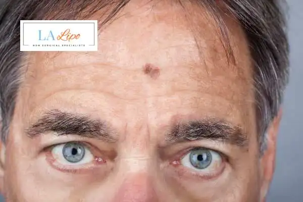 Solar Lentigo Removal Birkenhead image of man with mark on his forehead