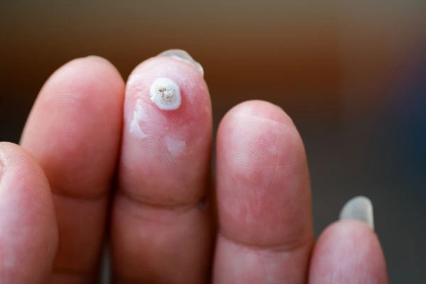 wart on person finger - cryotherapy to treat from LA LIPO Birkenhead