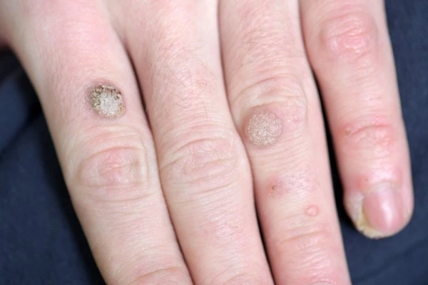 photo of warts on person hand - see wart removal Birkenhead from LA LIPO