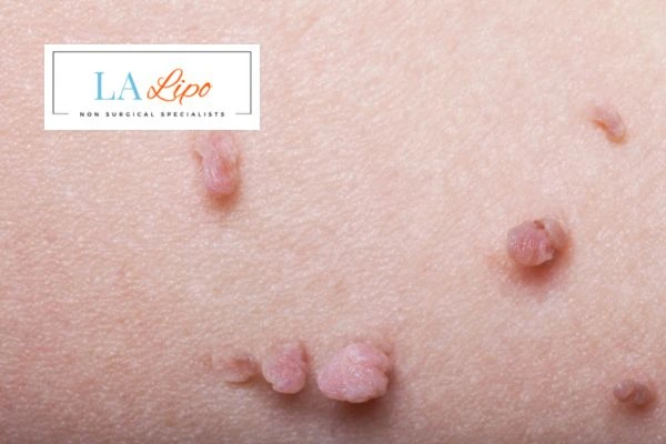 Does cryopen skin tag removal Birkenhead hurt? Find out now call our team today!