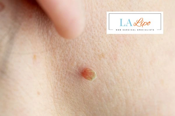 Book skin tag removal Birkenhead today speak to our team now!