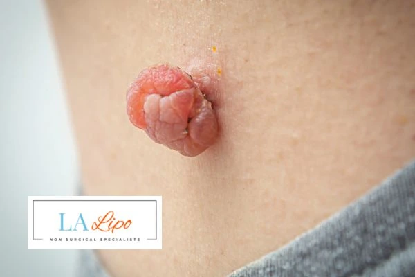 Interested in skin tag removal Birkenhead? Concerned about the pain? Find out more today!