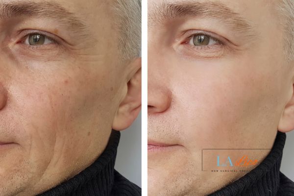 See the amazing results of Morpheus8 Treatment Birkenhead!