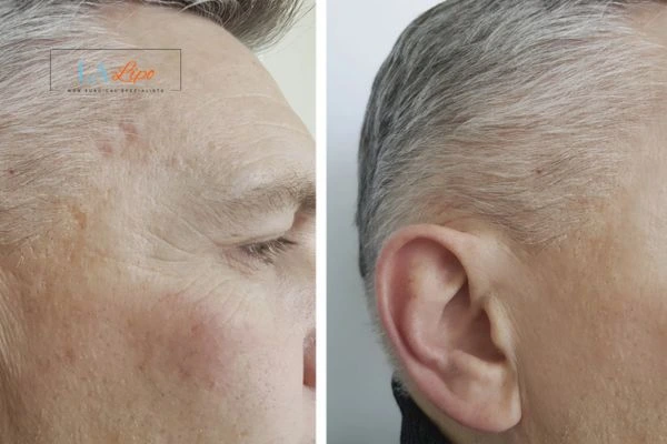 Mens Before & After Morpheus 8 Results Birkenhead