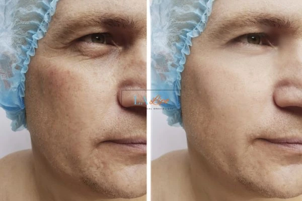 Before and after Morpheus 8 Results Birkenhead