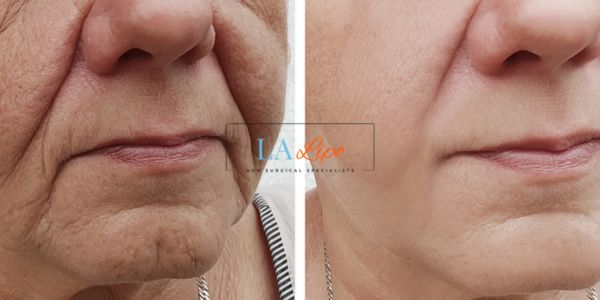 Older lady deeper wrinkle reduction - LA LIPO Morpheus 8 Results Birkenhead