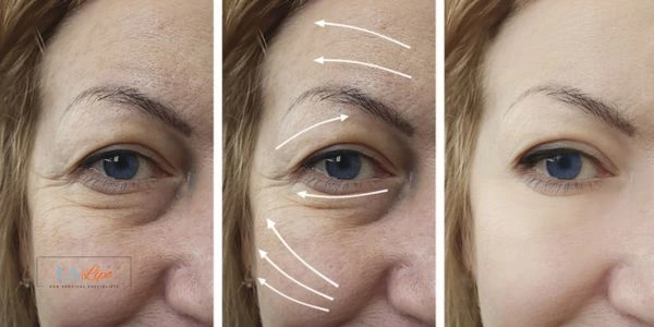 Amazing eye lift Morpheus 8 results Birkenhead