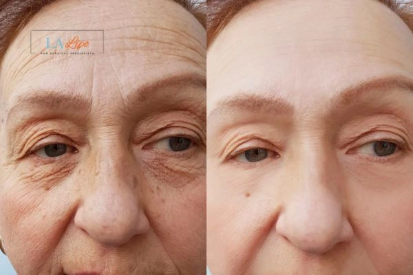 The powerful benefits of Morpheus8 Treatment Birkenhead - Call Our team today!