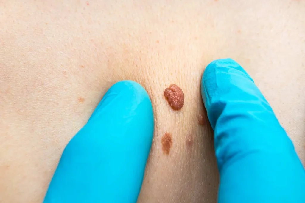 LA LIPO Cryopen Lesion Removal Prices Birkenhead