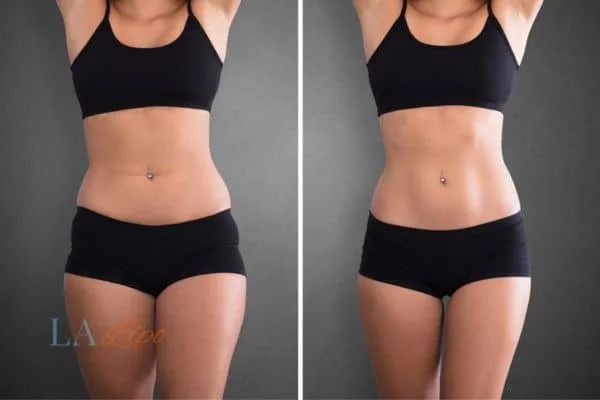 before and after results of non-surgical treatment to help a woman's body image and mental health Birkenhead