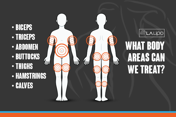 Diagram to show areas you can have LA-EMS Body Sculpting Treatment Birkenhead