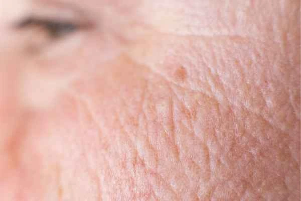 close up picture of a woman's face showing an age spot Birkenhead
