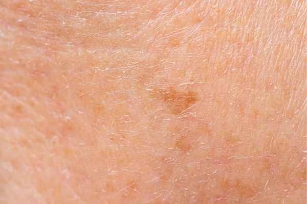 close up picture of age spots Birkenhead