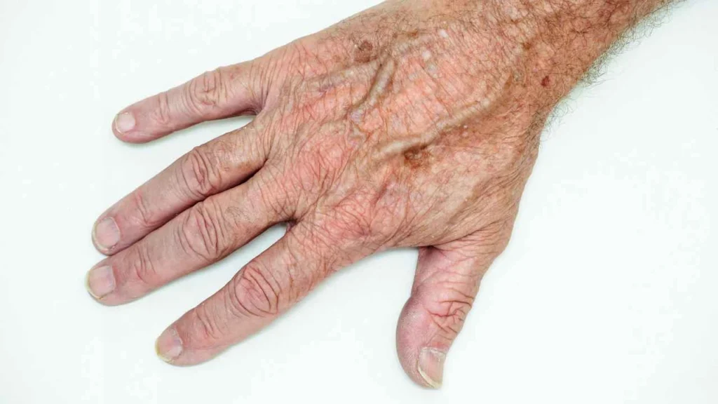 Male hand showing age spot Birkenhead
