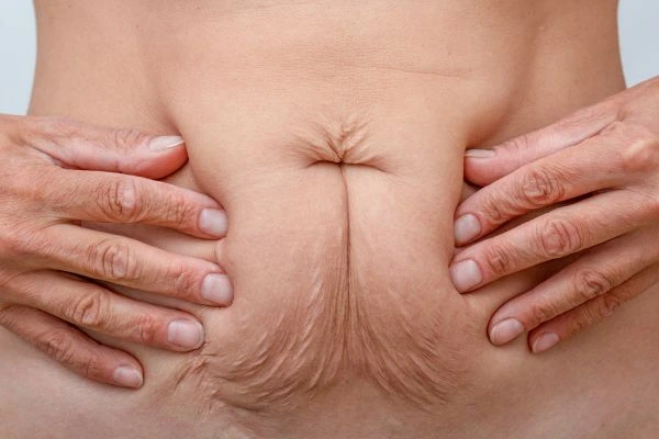 Image of a woman's stomach with loose skin - example of skin tightening Birkenhead options