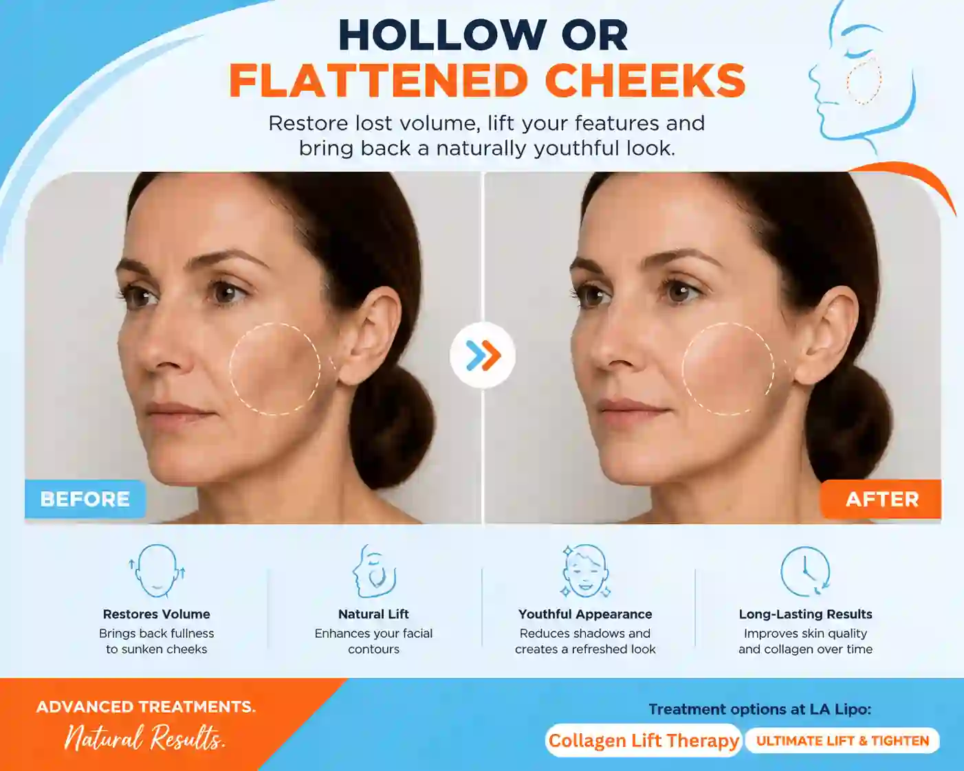 Sign #4: Hollow or Flattened Cheeks Birkenhead