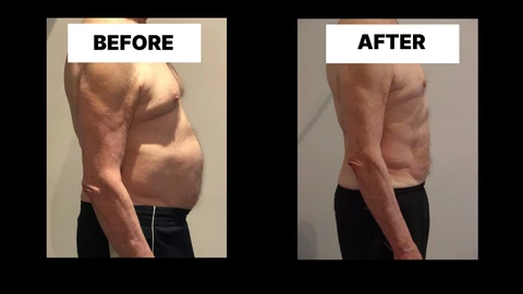 What Symptoms Can Diastasis Recti Cause in Men? Weak Core, Back Pain and Poor Posture Birkenhead